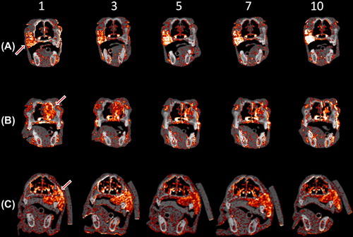 Figure 1. Contrast-enhanced cone beam CT images of patients A–C. The numbers corresponds to the treatment fractions where imaging was performed. The tumor is indicated by an arrow. The contrast enhancement window was [10,100] HU.