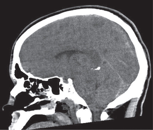 Figure 1. Head CT (sagittal view) showing cerebral edema and tonsillar herniation.