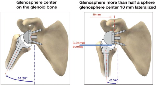 Figure 10. Explanation of the dilemma of Gutiérrez: a prosthetic overhang can also be created by the prosthesis if the center of rotation is lateralized and if the glenosphere is more than half a sphere.