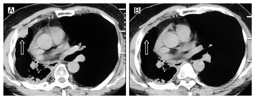 Figure 5. Tumor volume changes seen on CT (A) before the third erlotinib treatment; (B) 2 mo after the third time erlotinib treatment.