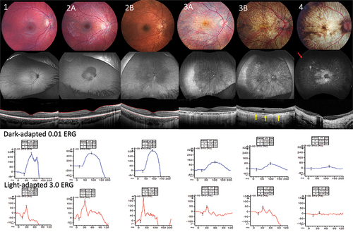 Figure 1. First row; fundus images representing from stage 1 to 4. Second row representing fundus autofluorescence start from speckle hypoautofluorescence mostly within vascular arcades in stage 2A progressing to nearly total dense hypoautofluorescence towards periphery in stage 4 (red arrow) third row demonstrates cross-sectional OCT scan of central macular area comparing each stages, severe attenuation of choroid was observed by OCT in stage 3B.(yellow arrow) fourth and fifth rows showing scotopic ERG and photopic ERG response respectively, amplitude of b wave gradually decline in more advance stages.