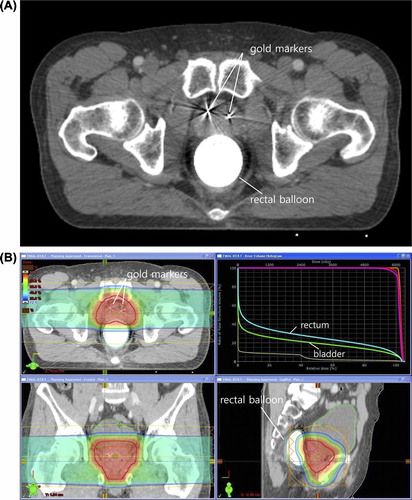 Figure 1. (A) A set of 3-mm-thick contrast computed tomography images was acquired for treatment planning. Three gold markers were inserted into the prostate. One of the three gold markers is not seen because it was inserted into a different axis. A balloon was inserted into the rectum and filled with 100 ml of saline. (B) Treatment planning was performed using bilateral beams with the Eclipse proton beam planning system (Ver. 8.1; Varian Medical System, Palo Alto, CA, USA). The planning goals included that at least 95% of the PTV received the prescribed dose, and that the volume receiving 50 Gy EQD2 should not exceed 30% for the rectum and bladder.