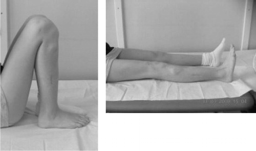 Figure 3. Range of motion 4 months postoperatively, after 5.5 cm of lengthening of the tibia.