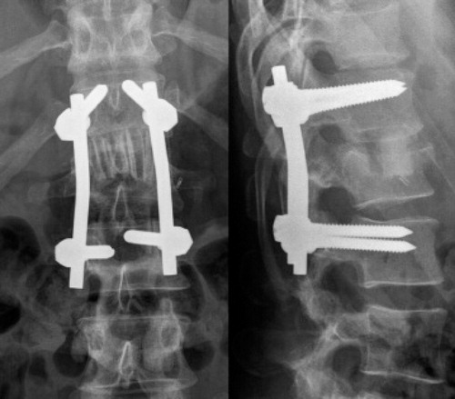Figure 1. Anteroposterior (left) and lateral (right) view of the thoracolumbar spine (T11 to L3) on postoperative radiographs after an AO type B2.3 fracture of L1. Bisegmental posterior instrumentation from T12 to L2 and anterior spondylodesis from T12 to L1 using an autologous rib graft was performed. The image shows the rib strut grafts in situ, arranged like a palisade.