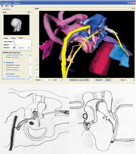 Figure 1. Image enhancement of the anatomical structures allowed with 3D modelling of the visible ear. Top: 3D reconstruction of the middle ear cavities. The ossicular chain appears in blue, the facial nerve in yellow, the cochlea–vestibular apparatus in pink, the carotid artery in red, and the auditory tube in light blue. Bottom: drawings of axial and coronal sections of the middle ear cavities. At least two drawings are required to give information about the 3D arrangement of the structures, whereas the 3D model provides this information directly taking advantage of the 360° rotation to explore several angles of view. Superposition of images or the masking of elements enables the completion or simplification (focussing on, e.g. the auditory ossicles) of the model.