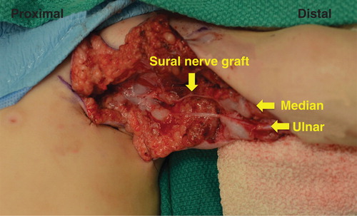 Figure 3. Sural nerve was used to bridge the 5-cm defect in both the median and ulnar nerves with 9-0 nylon and Tisseel fibrin glue. Radial nerve exploration was not undertaken due to vascular threat to limb at this stage of operation.