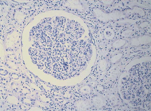Figure 1. Renal biopsy of the patient revealed mesangial cellularity with mesangial cells and neutrophils, endocapillary proliferation, and obliterated capillary loops.