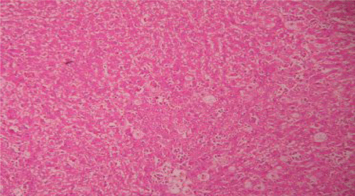 Figure 6.  Liver section of CCl4 rats showing fatty changes, necrosis and filtration of lymphocytes.
