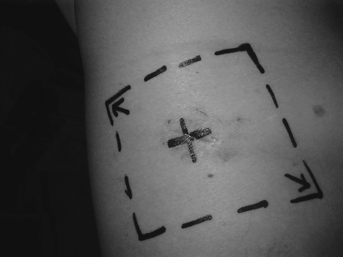Figure 1.  Thoracoscopy scar site covered by 10×10 cm square radiation field.