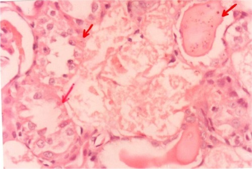 Figure 10 A photomicrograph of the kidney of an mercury-treated rat. The red arrows showing necrotic changes of the rental tubular cells and some tubles contain casts, ×400 magnification.
