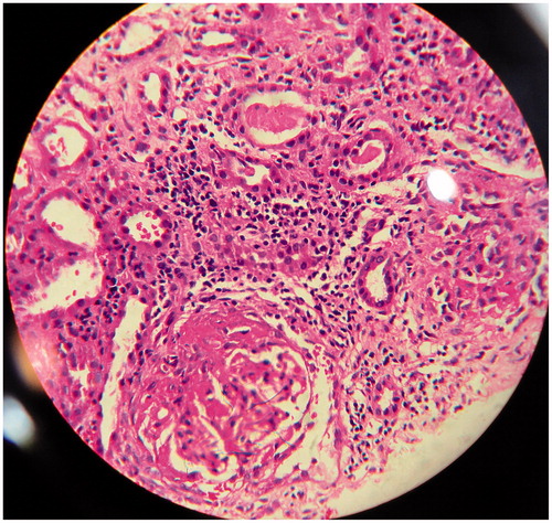 Figure 1. Light microscopy showing a fibrocellular crescent.