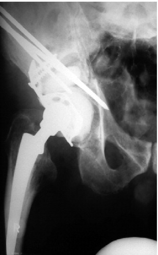 Figure 2. Periacetabular reconstruction with modified Harrington technique and total hip replacement. Unthreaded pin is marked with an arrow.