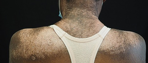 Figure 7 Salt-and-pepper dyspigmentation can be the presenting finding in patients with systemic sclerosis and a leading cause of body image dissatisfaction in patients with skin of color.