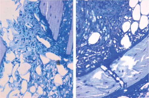 Figure 2. The cellular proliferation occurred in the marrow inter-trabecular space and on the surface of pre-existing trabeculae. The shape of the cells was spindle-like or polygon-like, and they retained the appearance of mesenchymal cells (Giemsa stain, 200× magnification).