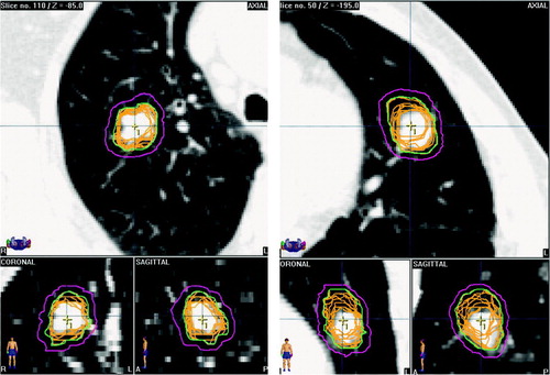 Figure 1.  Two examples of individualized PTV generation for SRT of lung cancer using 4DCT scans. GTVs are contoured in each of the 10 phase bins of the 4DCT, and the ITV is defined as the volume encompassing all GTVs. A CTV to PTV margin of 3 mm is added to the ITV to derive the individualized PTV.