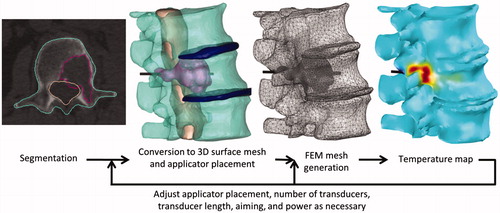 Figure 2. Process by which patient-specific simulations are created. 3D anatomy in a CT scan is segmented and converted into 3D surface meshes. The surface meshes of the anatomy and of a cylinder representing the applicator are combined and then converted into a finite element method (FEM) mesh, on which temperature and thermal dose are calculated.