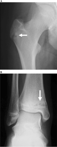 Figure 5.  Radiographs show small and round osteolytic lesions (arrows) in the greater trochanter of the right femur (A) and the distal tibia (B).