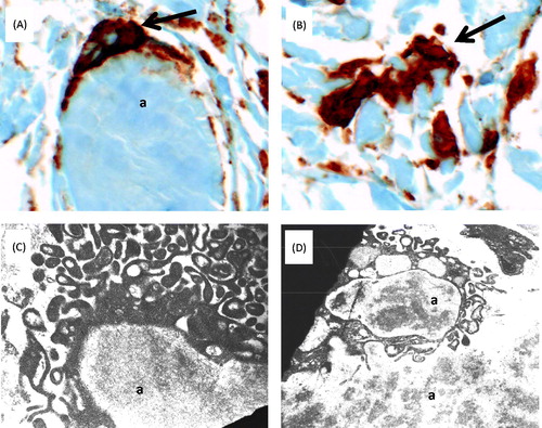 Figure 4. Amyloid phagocytosis in synovial tissue from patient 1. (A) and (B) Immunohistochemial detection of CD68+ macrophages (brown) engulfing (A) and interdigitating with (B) amorphous amyloid deposits (original magnification 400×). (C) and (D) Ultrastructural findings. (C) Phagocyte reacting to and surrounding a mass of amyloid (a); magnification approximately 12 000×. (D) Cell with completed amyloid phagocytosis; magnification approximately 7000×. Images were acquired with a Zeiss EM-10 transmission electron microscope, using thin sections from epoxy-embedded tissue. Tissue was obtained during the same biopsies as in Figure 1. Abbreviation: a, amyloid.