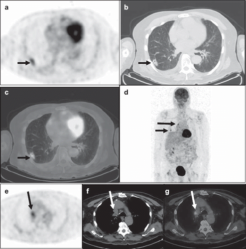 Figure 2. A 71-year-old man was admitted with delirium and fever. An MRI of the brain with and without contrast showed subacute ischemic of the left posterior frontal and parietal lobes. Blood cultures, lumbar puncture and bronchoalveolar lavage were negative for infectious pathogens. Diagnostic CT of the chest showed a right lower lung lobe nodule and an enlarged right tracheobronchial lymph node for which the FDG PET/CT was ordered for further evaluation. Axial PET (a), CT (b) and fused PET/CT (c) images demonstrated a spiculated 2.5 × 1.2 cm right lower lung lobe nodule with prominent FDG uptake (SUVmax 3.8), short arrow. This lesion (short arrow) was seen in the maximum-intensity-projection (MIP) image (d), which also showed a hypermetabolic focus in the right tracheobronchial region (long arrow). Axial PET (e), CT (f) and fused PET/CT (g) demonstrated an intensely hypermetabolic (SUVmax 4.2) right tracheobronchial lymph node measuring 1.7 × 1.5 cm in size (long arrow). The PET/CT findings were suspicious for lung primary with mediastinal metastasis. Subsequent core biopsy of the right lung nodule revealed granulomatous disease with abundant yeasts. Following antifungal treatment, the patient was afebrile on 3-month follow-up, and the right lung nodule and mediastinal lymph node resolved on chest CT.