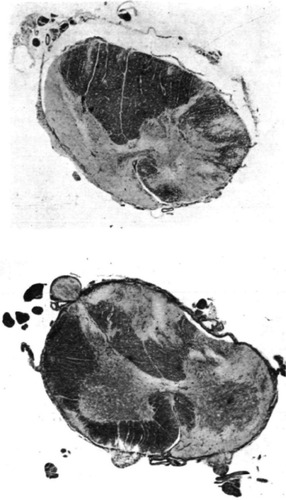 Figure 1 Sections from the 11th thoracic and 3rd lumbar segments, using Loyez myelin stain, revealed irregular regions of degeneration in the white matter.Reprinted from Greenfield JG, Turner JWA. Acute and subacute necrotic myelitis. Brain. 1939;62:227–252 with permission from Oxford University Press.