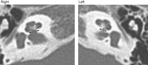 Figure 1. Measurement of the CNC on CT images. The width at the inner margin of its bony walls at the base of the modiolus was measured. The CNC is indicated on the images by arrows.
