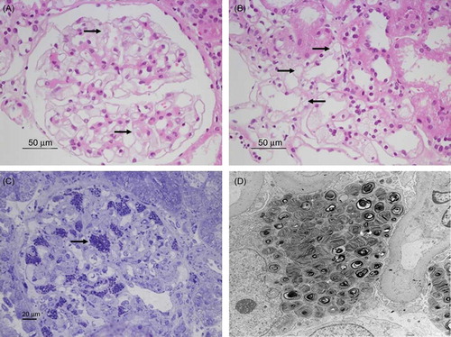 Figure 2. Renal biopsy findings. (A) Hematoxylin and eosin (H&E) staining. Podocytes of the glomeruli display a foamy appearance and an expanded cytoplasm (×400). (B) H&E staining. Foamy tubular epithelial cells are shown (×400). (C) Toluidine blue staining. A semi-thin section stained with toluidine blue for electron microscopy shows inclusions within the cytoplasm of the podocytes (×200). (D) Electron microscopy. Diffuse, whorled myelin figures in the cytoplasm of the podocytes are shown (×3000).
