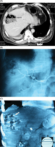 Figure 3. (a-c) transverse CT scan and digital subtraction angiography (DSA) shows abscess formation and a small account of bleeding in abscess cavity. A 53-year-old man had a symptom of bloody stool shortly after MWA of intrahepatic metastasis. (a) Transverse CT scan shows an abscess formation following MRA which had a large fluid- and air-filled cavity (arrow). (b) Hepatic arteriography hadn't found bleeding. (c) Coronal reconstruction of post-arteriography CT shows there was contrast agent deposition inside and around the ablation zone (arrow) in venous phase which help to deduce that there was a small number of active bleeding surrounding ablation zone.