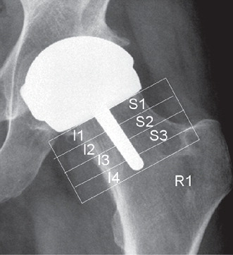 Figure 1.  The superior and inferior zones of the femoral neck after Birmingham hip resurfacing.
