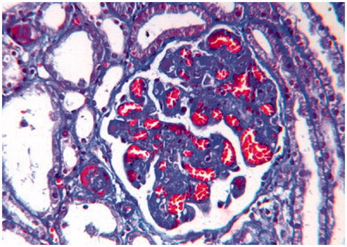 Figure 2. Glomerulus from a H & E stained section, showing significant loss of mesangial matrix, with a fluffy appearing remaining mesangial area and retraction of capillary tufts (mensagiolysis). The glomerular capillaries are congested and dilated (H&E × 250).