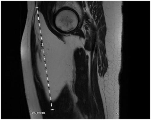 Figure 2. Sagittal section of MRI of lipoma.
