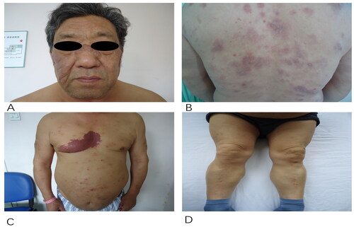 Figure 1. Clinical examination revealed scattered red plaques, papules and nodules on his face (a), limbs (C,D), and trunk (B,C).