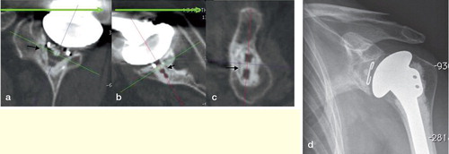 Figure 4. Radiolucent line at the cement-bone interface (black arrows) visualized by using the described protocol, in the sagittal plane of the glenoid implant (a), in the axial plane of the middle part of the implant (b), in the coronal plane of the implant, passing through the keel hole (c). Plain radiograph of the same shoulder for comparison (d).