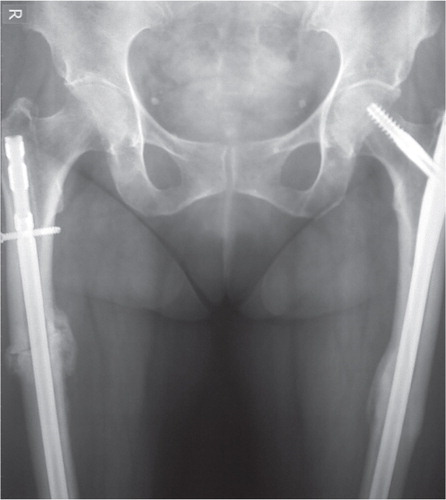 Figure 3. Anteroposterior radiograph of both femurs 5 months after the second operation, showing healing of the fracture with callus formation.