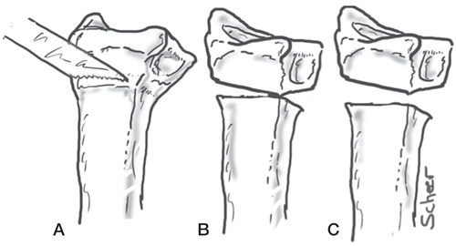 Figure 1. Left radius, ulnopalmar view. The osteotomy will commonly pivot around the ulnopalmar corner to correct dorsal and radial malangulation as well as malrotation. A. Osteotomy done in line with the previous fracture. B. Triangular defect in 2 planes. C. Trapezoid defect in 2 planes.