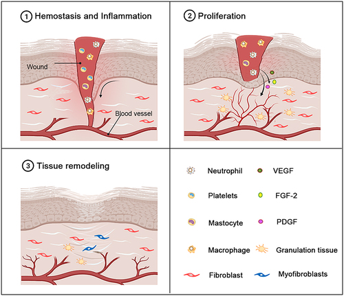 Figure 2 The different stages of normal wound healing. Normal wound healing is a complex biological process that can be divided into three stages: the hemostasis and inflammatory stage, the proliferation stage and the tissue remodeling stage. The inflammatory stage occurs shortly after injury and is characterized by the influx of inflammatory factors. In response to inflammatory signals, neutrophils, macrophages and mast cells are migrate to the wound. As the inflammatory stage subsides and the proliferative phase of tissue repair begins, the dermis and epidermal cells migrate and proliferate excessively in the wound bed. Epithelialization, collagen deposition, angiogenesis, and formation of granulation tissue occur during this stage. The beginning of the stage of tissue remodeling is characterized by matrix remodeling and decreased cell density. At this stage, the wound undergoes contraction to form a scar.