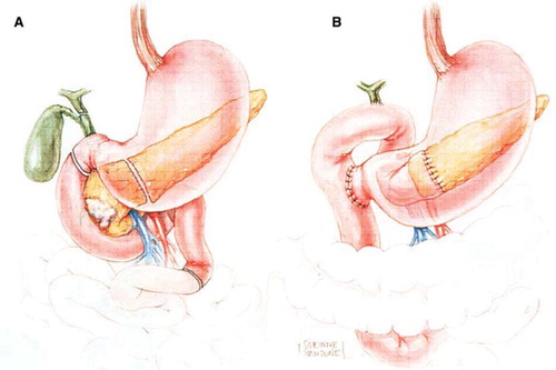 Figure 4. Diagram of the resection (A) and final reconstruction (B) after pylorus-sparing pancreaticoduodenectomy. (Adapted from Cameron JL, Sandone C. Atlas of Gastointestinal Surgery, 2md ed. Vol 1. Hamilton, Ontario: BC Decker, Inc.; 2007:302.)