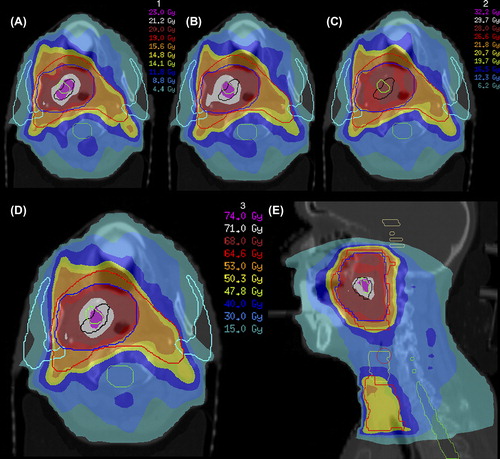 Figure 3. Dose-escalation to GTV80%1 (as delineated using a cut-off of 80% of maximum tumor uptake signal in a 18F-FLT PET-CT scan performed before start of radiotherapy) and GTV80%2 (as delineated in a 18F-FLT PET-CT scan performed after 1 week of radiotherapy) for a cT3N0M0 oropharyngeal tumor. Using IMRT with integrated simultaneous boost technique, total dose was 50.3 Gy to bilateral cervical lymph node regions (large planning target volume, red) and 68 Gy to primary tumor (small planning target volume, blue); in 34 fractions. GTV80%1 (black) and GTV80%2 (green) were consecutively irradiated with 2.3 Gy for 10 fractions, resulting in a dose of 71 Gy in total and a dose of 74 Gy in the overlapping region. (A and B) Dose distributions for first 2 weeks of treatment (A) and weeks 3 and 4 (B). (C) Dose distribution for remaining 14 fractions without dose-escalation. (D and E) Dose distributions of total treatment plan in transverse (D) and sagittal (E) planes. Parotid glands are delineated in sky blue and spinal cord in green. This figure was originally published in JNM. Troost EG, Bussink J, Hoffmann AL, Boerman OC, Oyen WJ, Kaanders JH. 18F-FLT PET/CT for early response monitoring and dose-escalation in oropharyngeal tumors. J Nucl Med 2010;51:866–74. © by the Society of Nuclear Medicine and Molecular Imaging, Inc.