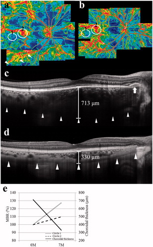 FIGURE 2. Laser speckle flowgraphy (LSFG) (a, b) and enhanced-depth imaging optical coherence tomography (EDI-OCT) (c, d) findings at pretreatment (a, c) and 7 months after treatment (b, d). (a) Panorama color map of LSFG showing decreased mean blur rate (MBR) over a wider area (arrowheads) than the hypofluorescent area observed on ICGA (Figure 1c). Blue and red indicate decreased and increased MBR, respectively. (b) The area of decreased MBR diminished in the posterior pole compared to that of the initial visit (a). (c) Horizontal EDI-OCT through the fovea showing markedly increased choroidal thickness and a hyperreflective lesion at subretinal pigment epithelium level (arrow) with shallow serous retinal detachment corresponding to the peripapillary choroiditis plaques. (d) Central choroidal thickness dramatically decreased with resolution of pigment epithelial detachment. (e) The graph shows the changes in the average MBR and subfoveal choroidal thickness during systemic corticosteroid therapy. The average MBR showed 27.4% increase in a lesion site (circle 1 shown in Figure 2a, b) and 9.7% increase in a normal-appearing retinal site (circle 2 shown in Figure 2a, b) at 7 months after treatment, compared to the pretreatment level (100%). Subfoveal choroidal thickness decreased from 713 µm to 330 µm.