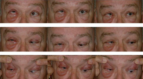 Figure 7. A patient with thyroid eye disease exhibiting prominent exophthalmos that is greater in the right eye, with significant restriction of right eye movement.