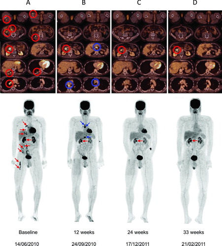 Figure 2  (Top) Axial sections of total body 18FDG-PET/CT scans in Patient B at baseline and evaluation in Weeks 12, 24, and 33 following initiation of ipilimumab 3 mg/kg. (A) Baseline: presence of metastases in the quadriceps and hamstring muscles, mesenteric, duodenal, lung, and several mediastinal locations. Melanoma metastases are indicated by red circles. (B) Images at 12 weeks showing disappearance of metastases in the quadriceps and hamstring muscles, metabolic normalization of mesenteric metastases and disappearance of lung metastases; metabolic activity persisted in the duodenal lesion and two new mediastinal lymph node metastases and a new peri-hepatic lymph node metastasis appeared (blue circles). (C) Images at 24 weeks after initiation of ipilimumab showing disappearance of mediastinal and peri-hepatic lymph node metastases and persistent activity of the duodenal lesion. (D) At 33 weeks after initiation of ipilimumab, there was a continuing response of all previously active lesions with the exception of persistence of 18FDG-uptake in the duodenal lesion. (Bottom) Corresponding coronal maximal-intensity-projection PET whole body scans of Patient B at baseline and subsequent assessments.