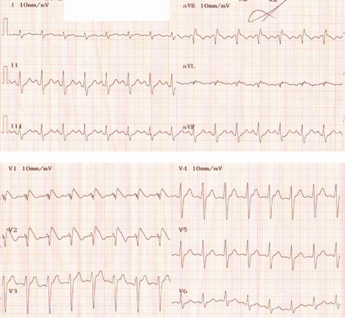 Fig. 1.  A 12-lead ECG taken on arrival to the emergency department showing BEP.