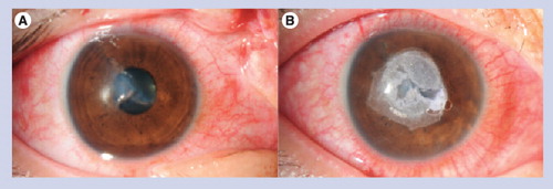 Figure 1. Sutureless sealing of a full-thickness stellate corneal laceration.(A) Full-thickness stellate corneal laceration. (B) Sealed with cyanoacrylate glue without sutures.