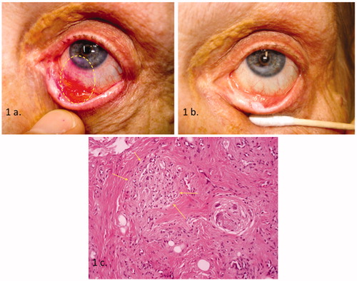 FIGURE 1. (a) Photograph of the affected eye shows an area of chronic inflammation with a high ratio of epithelial cell depletion. Corneal involvement is also shown as stromal infiltration (rose bengal staining-dotted ellipsoid). (b) The same eye photographed while patient was on topical steroids. A significant improvement of conjunctival injection is noted. However, a “cheesy” material overlying the erosive lesion as well as the corneal infiltration is still apparent. (c) Histologic examination of the lid biopsy shows chronic inflammation and fibrosis. Foreign body-type granulomas are also present (arrows) (×200 hematoxylin–eosin).
