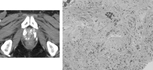Figure 1. Example of an unenhanced computed tomography scan obtained one year after a single injection of magnetic fluid into the prostate, followed by six thermotherapy sessions (left). Hyperdense nanoparticle deposits in the prostate are still clearly visible. Histology image obtained by prostate biopsy of the same patient 1 year after treatment (right). Iron-oxide nanoparticles (brown) are still present in the prostate tissue (hematoxylin-eosin staining, ×200).
