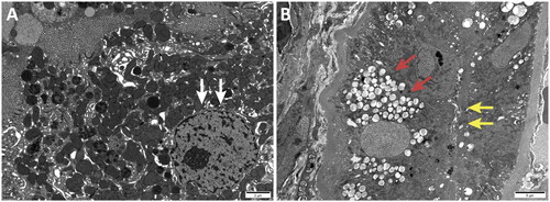 Figure 7. Electron microscopy: Renal tubular lesions including vacuolization (red arrows), granular degeneration (white arrows) and focal atrophy (yellow arrows) of epithelial cells were observed in the renal specimen.