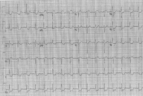 Figure 1. EKG showing T wave inversion in lead III, ST depression in I,II and V4-V6.