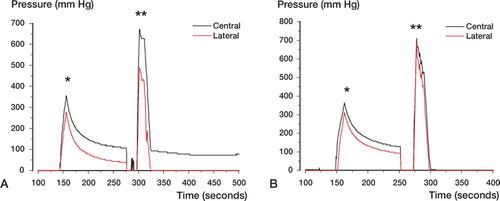 Figure 5. Pressure profile during cement pressurization (*) and cup insertion (**) in (A) group 1 (with initial cement pressurization at 2.5 minutes), and (B) group 2 (with cup introduction at 4.5 min).