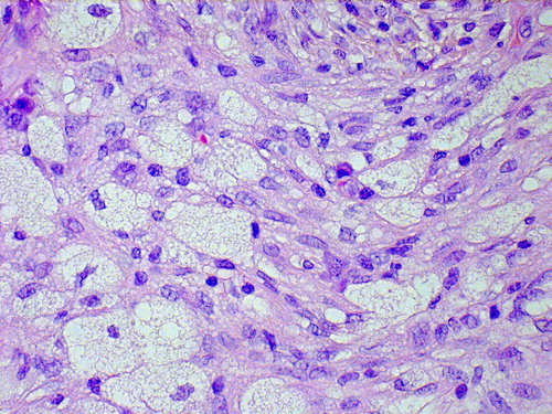 Figure 2. Routine histology (Htx-Eosin X60) showing typical appearance of macrophages (Xanthomous cells) in the tissue (first diagnosis in 2004).