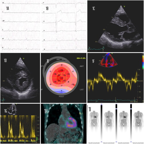 Figure 1. (A, B) Electrocardiogram - Atrial flutter and left bundle branch block.(C, D) Transthoracic echocardiography - Left ventricular hypertrophy (lVSd 12mm, PWd 10mm), along with speckled pattern in the myocardium. (E) Strain echocardiography - Speckled tracking revealed marked diminution of global longitudinal strain (-12) depicted in bulls-eye plot with apical sparing. (F, G) Tissue Doppler study revealed grade 2 left ventricular diastolic dysfunction (E/A mitral ratio 1,3, DT 210ms, E/è13,7). (H) Multiplanar single photon emission computed tomography (SPECT)- Showing myocardial tracer uptake, mostly in the left ventricle and septum with some heterogeneity in uptake intensity. (I) Pretreatment whole body 99mTc-3,3-diphosphono-1,2-propanodicarboxylic acid (DPD) scintigraphy - Showing very high 99mTc -DPD-uptake in the heart, Perugini grade 3.