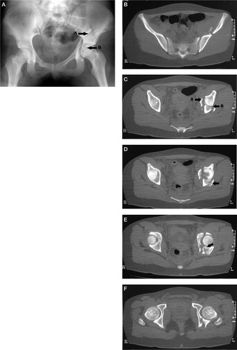 Figure 3. Patient no. 2 with an inverse T-fracture. In panel A, arrow A points to the vertical fracture line which divides and ascends to the crest and ant. sup. iliac spine. Arrow B points to the transverse fracture line. The axial scan in panel B shows the vertical fracture line which is also marked by arrow B in panel C. In this panel, arrow A marks the start of the transverse fracture. The posterior wall fragment is pointed out in panel D, and in panel E the distal end of the ileum with articular cartilage connected to the axial skeleton is marked with an arrow. Panel F shows the posterior wall fragment and there are no fracture lines involving the foramen obturatum.